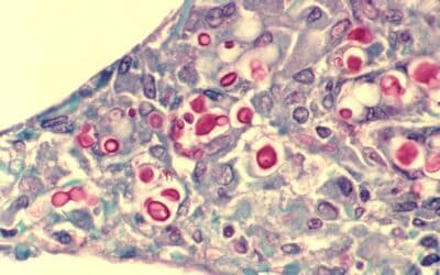 ¿Qué es la criptococosis?